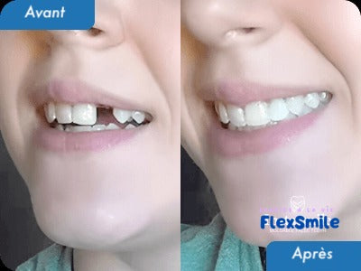 Flex-Smile® - Kit réparation dentaire