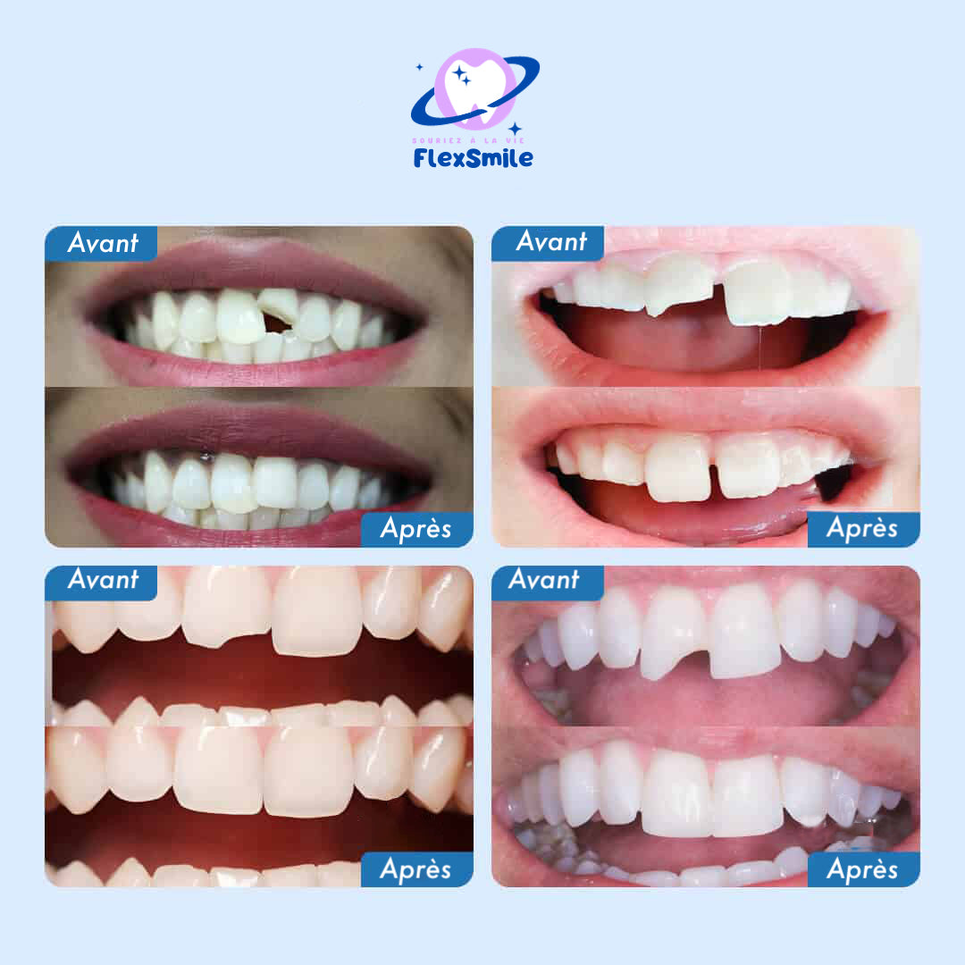 Flex-Smile® - Kit réparation dentaire